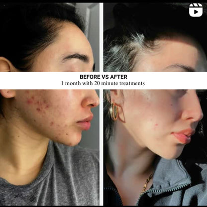 HSI: VISO Red Light Therapy Mask | FDA 510(k) Cleared