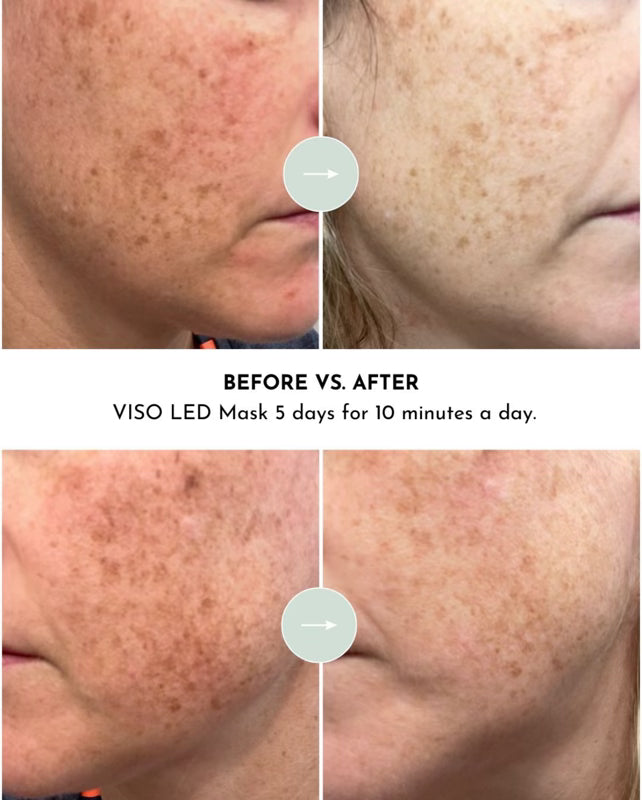 HSI: VISO Red Light Therapy Mask | FDA 510(k) Cleared